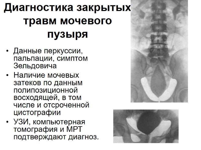 Диагностика закрытых травм мочевого пузыря Данные перкуссии, пальпации, симптом Зельдовича  Наличие мочевых затеков